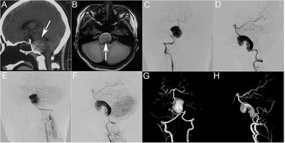 Pediatric Patient With a Giant Vertebrobasilar Dissecting Aneurysm Successfully Treated With Three Pipeline Embolization Devices